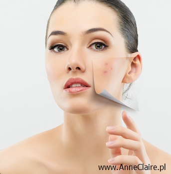 usuwanie trądziku leczenie laserem w salonie Anne Claire
